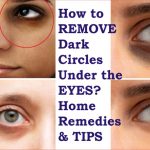 How to Remove Dark Circles Under Eyes Permanently: Effective Home Remedies and Tips